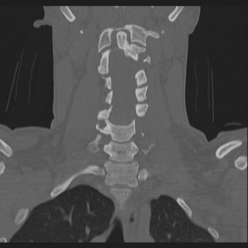 Bilateral locked facets (Radiopaedia 33850-35016 Coronal bone window 46).png