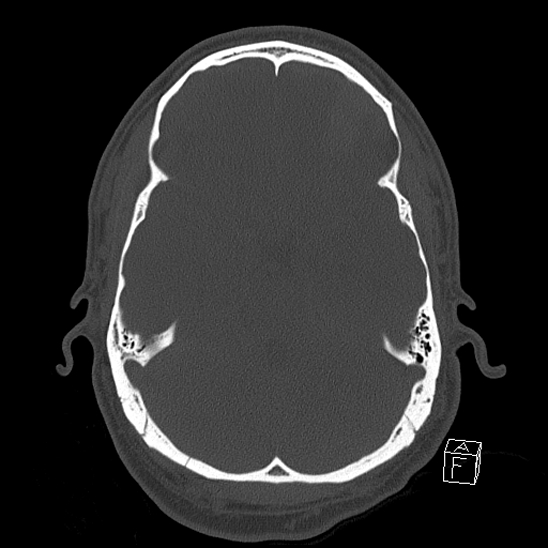 File:Bilateral occipital condyle fracture (type 2) (Radiopaedia 87675-104089 Axial bone window 46).jpg