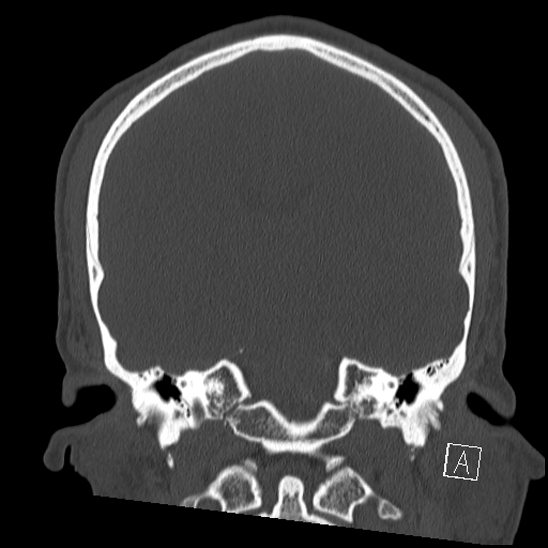 Bilateral occipital condyle fracture (type 2) (Radiopaedia 87675-104089 Coronal bone window 72).jpg