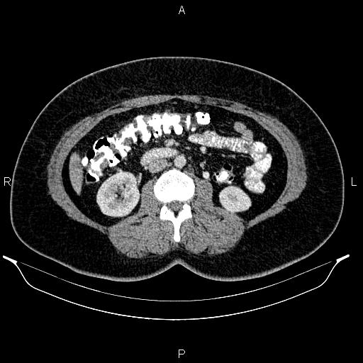 Bilateral ovarian dermoid cysts (Radiopaedia 85785-101603 A 53).jpg
