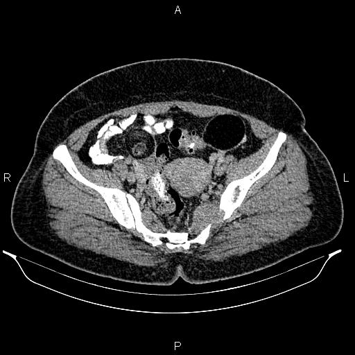Bilateral ovarian dermoid cysts (Radiopaedia 85785-101603 A 87).jpg