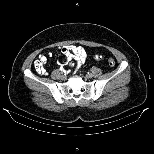 Bilateral ovarian dermoid cysts (Radiopaedia 85785-101603 Axial C+ delayed 60).jpg
