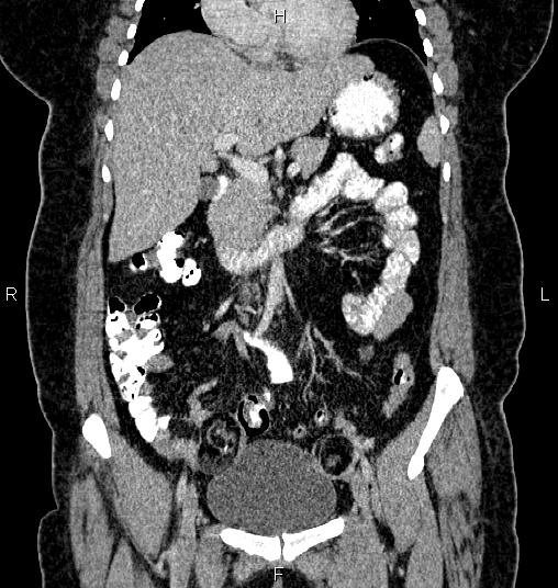 File:Bilateral ovarian dermoid cysts (Radiopaedia 85785-101603 C 20).jpg