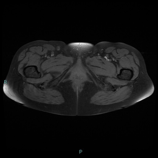 File:Bilateral ovarian fibroma (Radiopaedia 44568-48293 Axial T1 fat sat 31).jpg