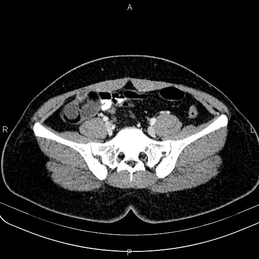Bilateral ovarian teratoma (Radiopaedia 83131-97503 Axial With contrast 22).jpg