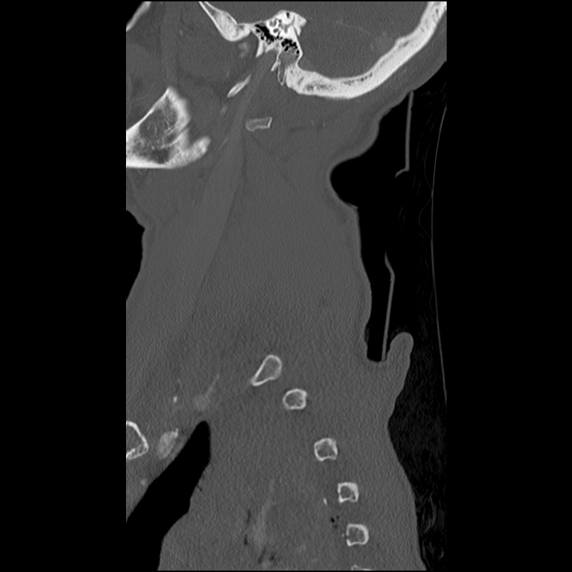 Bilateral perched facets with cord injury (Radiopaedia 45587-49713 Sagittal bone window 4).jpg