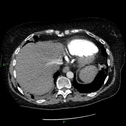 Bilateral pulmonary emboli (Radiopaedia 32700-33669 Axial C+ CTPA 90).jpg