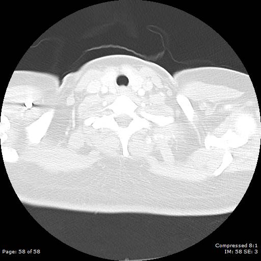 Bilateral pulmonary emboli with Hampton hump sign (Radiopaedia 54070-60246 Axial lung window 58).jpg