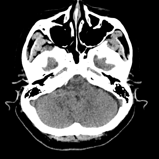 Bilateral subacute subdural hematoma (Radiopaedia 69240-79018 Axial non-contrast 10).jpg