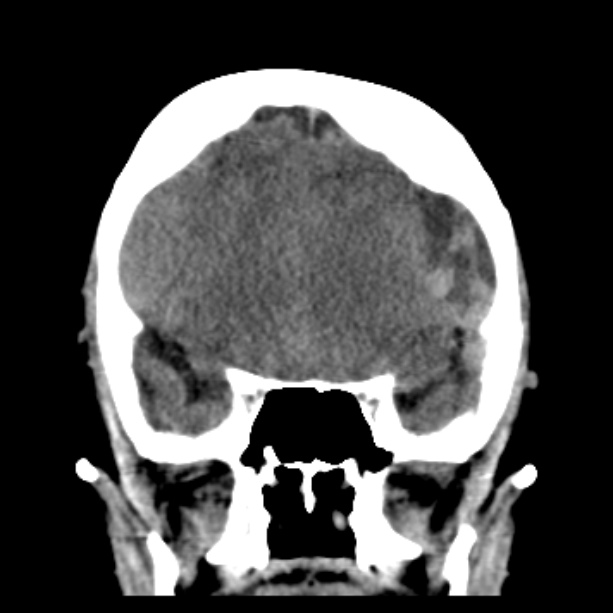 Bilateral subdural hemorrhages (Radiopaedia 26588-26732 Coronal non-contrast 21).jpg
