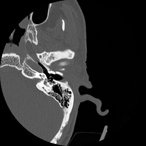 Bilateral temporal bone fractures (Radiopaedia 29482-29970 D 69).jpg