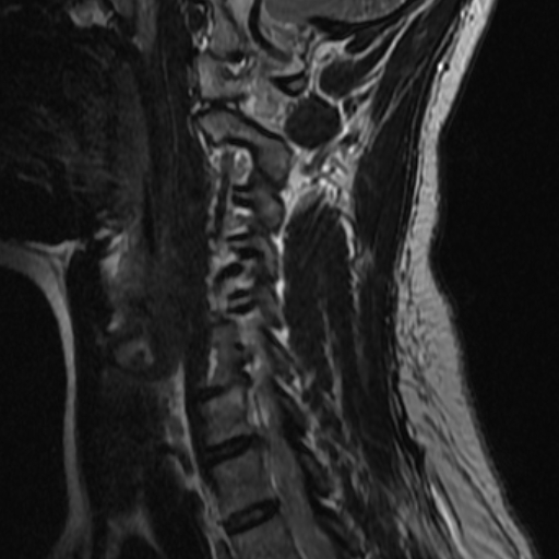 File:Bilateral tortuous vertebral arteries (Radiopaedia 19070-19039 Sagittal T2 7).jpg