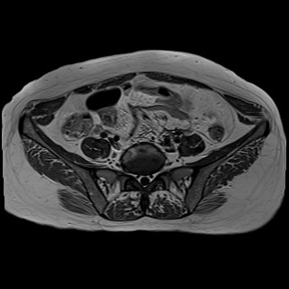 Bilateral tubo-ovarian abscesses (Radiopaedia 58635-65829 Axial T1 C+ 7).jpg