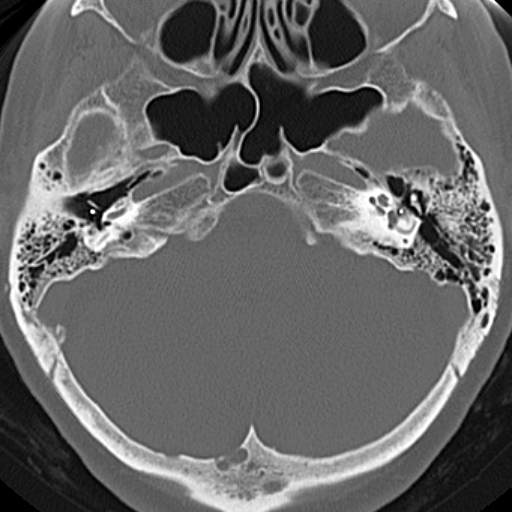File:Bilateral tympanoplasty (Radiopaedia 16947-16664 Axial bone window 14).jpg