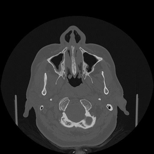File:Bisphosphonate-related osteonecrosis of the jaw (Radiopaedia 71324-81642 Axial bone window 126).jpg