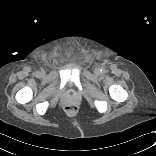 Bladder rupture post renal biopsy (Radiopaedia 30863-31572 Axial non-contrast 89).jpg