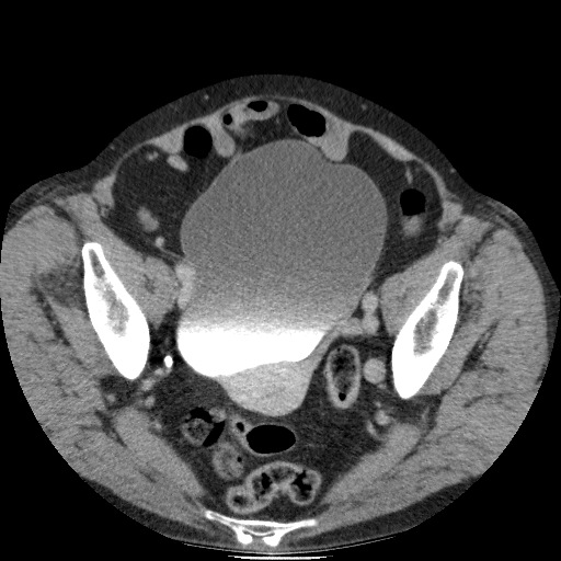 Bladder tumor detected on trauma CT (Radiopaedia 51809-57609 C 116).jpg