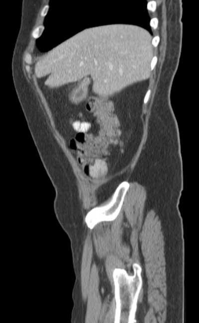 Bleeding duodenal ulcer and adenomyomatosis of gallbladder (Radiopaedia 61834-69861 C 16).jpg