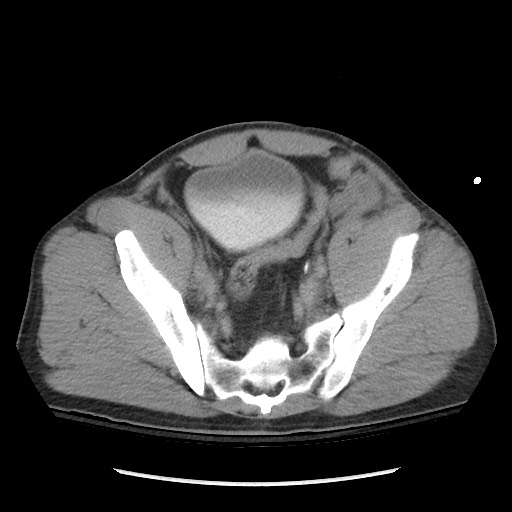 File:Blunt abdominal trauma with solid organ and musculoskelatal injury with active extravasation (Radiopaedia 68364-77895 Axial C+ delayed 113).jpg