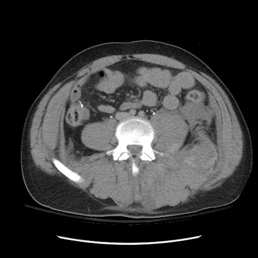 Blunt abdominal trauma with solid organ and musculoskelatal injury with active extravasation (Radiopaedia 68364-77895 Axial C+ delayed 85).jpg