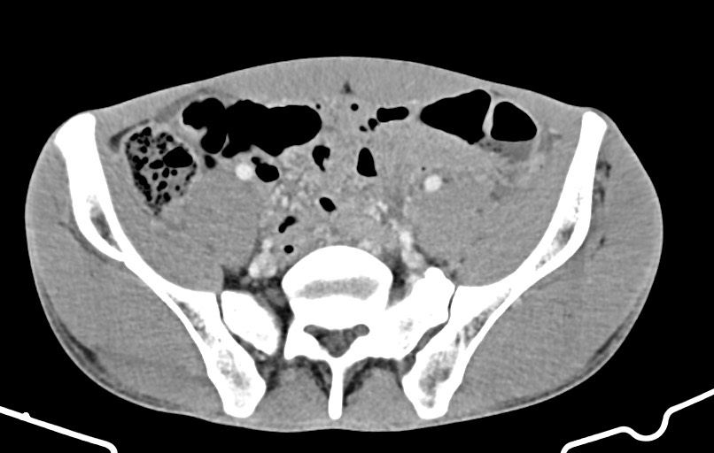 Blunt injury to the small bowel (Radiopaedia 74953-85987 A 144).jpg