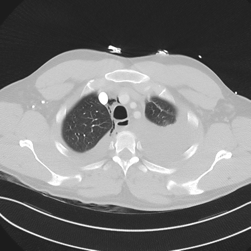 Boerhaave syndrome (Radiopaedia 39382-41660 Axial lung window 11).png