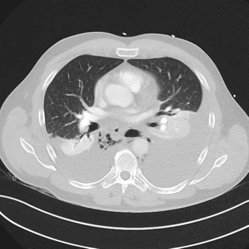 File:Boerhaave syndrome (Radiopaedia 39382-41660 Axial lung window 28).png