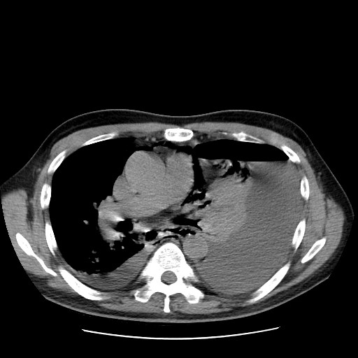 Boerhaave syndrome (Radiopaedia 59796-67310 Axial liver window 31).jpg