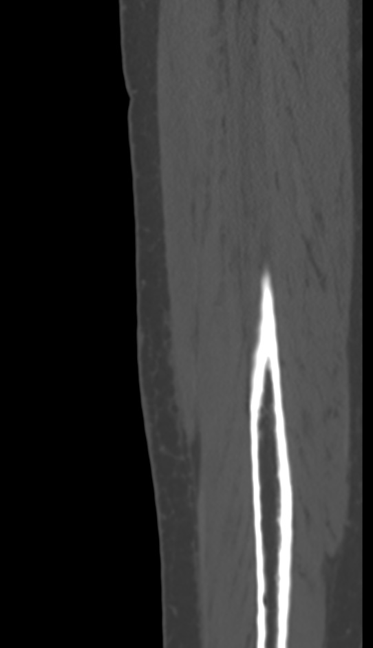 Bone metastasis - tibia (Radiopaedia 57665-64609 Sagittal bone window 154).jpg