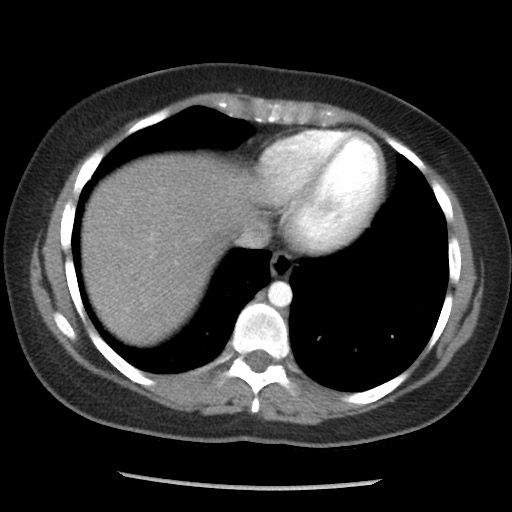 File:Borderline mucinous tumor (ovary) (Radiopaedia 78228-90808 A 35).jpg