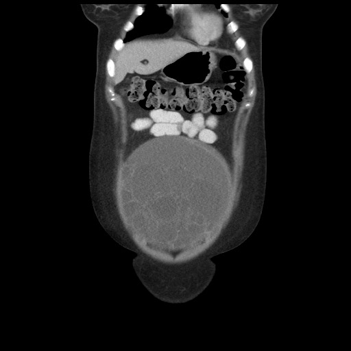 Borderline mucinous tumor (ovary) (Radiopaedia 78228-90808 C 12).jpg