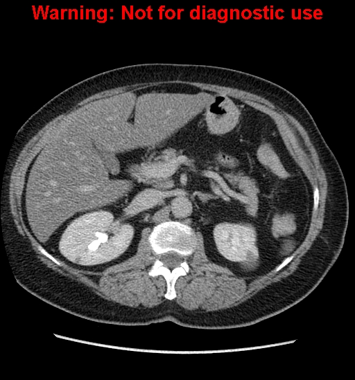 File:Bosniak renal cyst - type II (Radiopaedia 23404-23468 F 20).jpg
