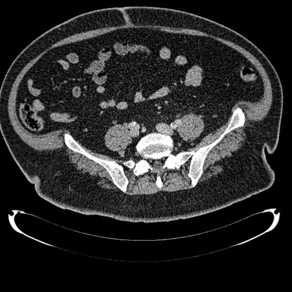 Bosniak renal cyst - type IV (Radiopaedia 24244-24518 C 277).jpg