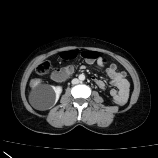 Bosniak renal cyst - type I (Radiopaedia 27479-27675 C 46).jpg