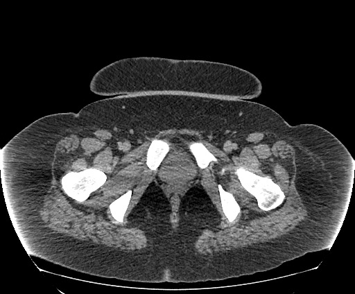 File:Bowel and splenic infarcts in acute lymphocytic leukemia (Radiopaedia 61055-68913 A 124).jpg