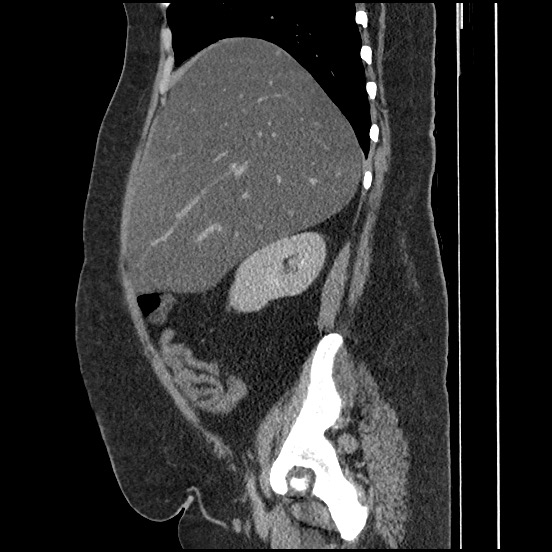 Bowel and splenic infarcts in acute lymphocytic leukemia (Radiopaedia 61055-68913 C 55).jpg