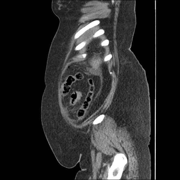 Bowel and splenic infarcts in acute lymphocytic leukemia (Radiopaedia 61055-68915 C 13).jpg