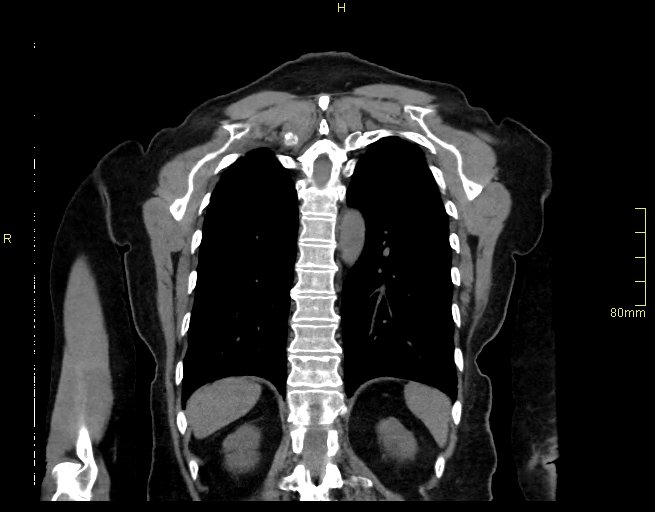 Brachial artery foreign body (Radiopaedia 54583-60820 Coronal non-contrast 46).jpg
