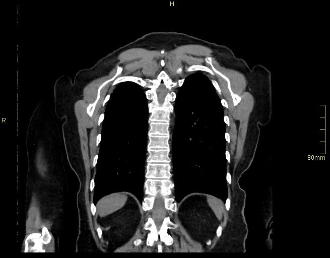 Brachial artery foreign body (Radiopaedia 54583-60820 Coronal non-contrast 48).jpg