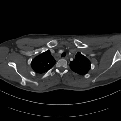 Brachiocephalic trunk pseudoaneurysm (Radiopaedia 70978-81191 Axial bone window 53).jpg