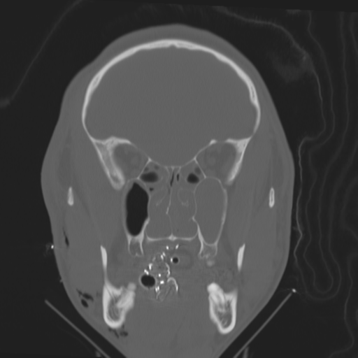 Brain contusions, internal carotid artery dissection and base of skull fracture (Radiopaedia 34089-35339 Coronal bone window 24).png