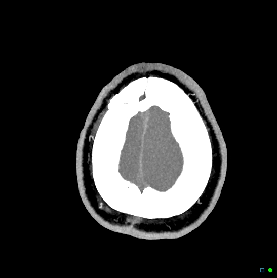Brain death on MRI and CT angiography (Radiopaedia 42560-45841 B 6).jpg