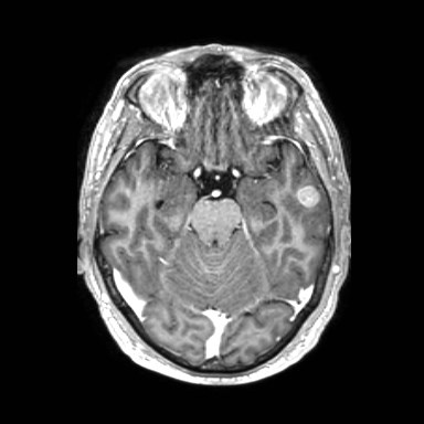 Brain metastases from lung cancer (Radiopaedia 83839-99028 Axial T1 C+ 21).jpg