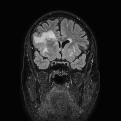 Brain metastases from lung cancer (Radiopaedia 83839-99028 Coronal FLAIR 26).jpg