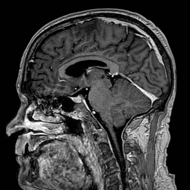 Brain metastases from lung cancer (Radiopaedia 83839-99028 Sagittal T1 C+ 34).jpg