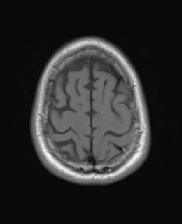 File:Brain metastasis (large cystic mass) (Radiopaedia 47497-52107 Axial T1 24).png