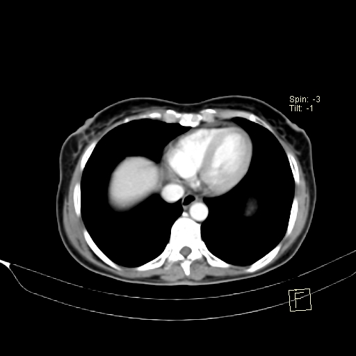 Brain metastasis as initial presentation of non-small cell lung cancer (Radiopaedia 65122-74127 A 35).jpg