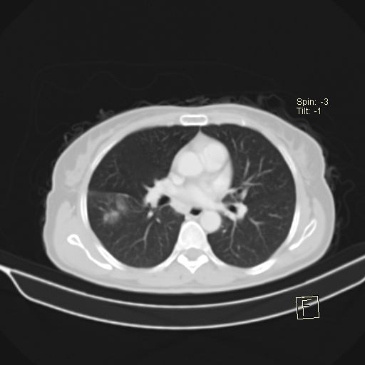 Brain metastasis as initial presentation of non-small cell lung cancer (Radiopaedia 65122-74127 Axial lung window 24).jpg