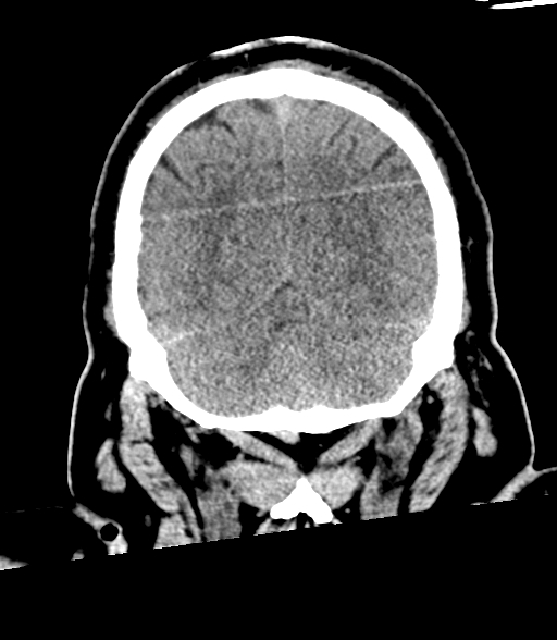 Brainstem hemorrhage (Radiopaedia 81294-94976 Coronal non-contrast 55).jpg