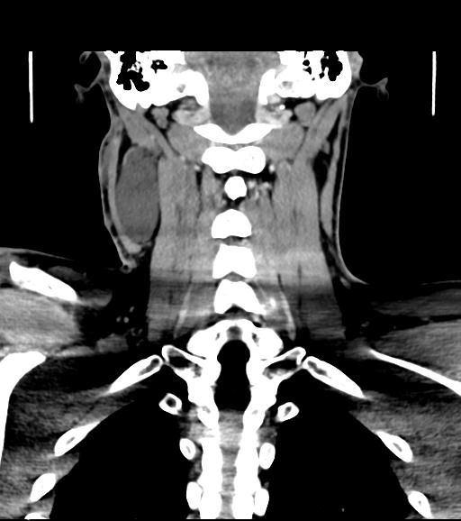 Branchial cleft cyst (Radiopaedia 31167-31875 Coronal C+ delayed 46).jpg